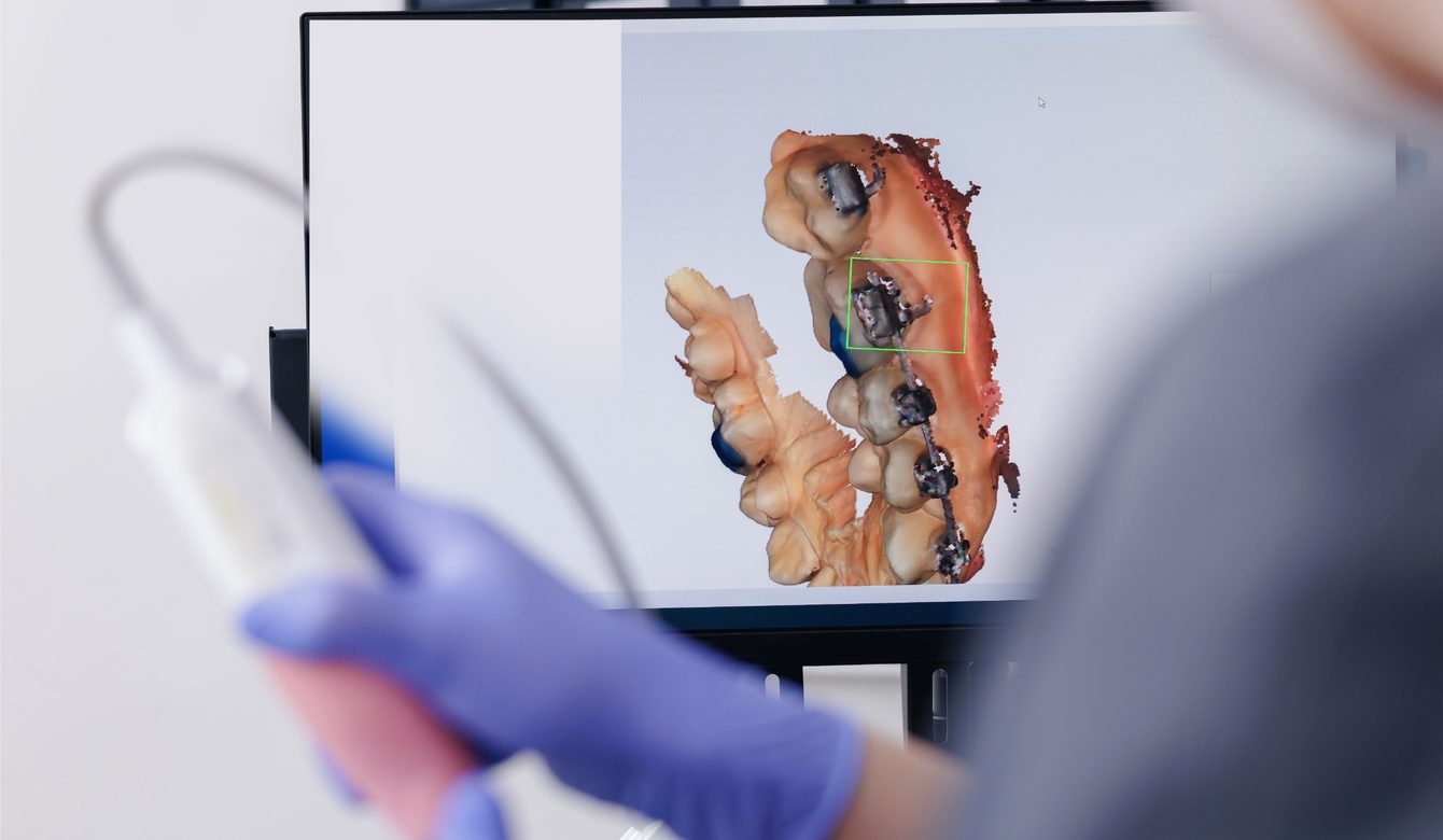 Digital scan of a patient&rsquo;s teeth on screen during an intraoral scan