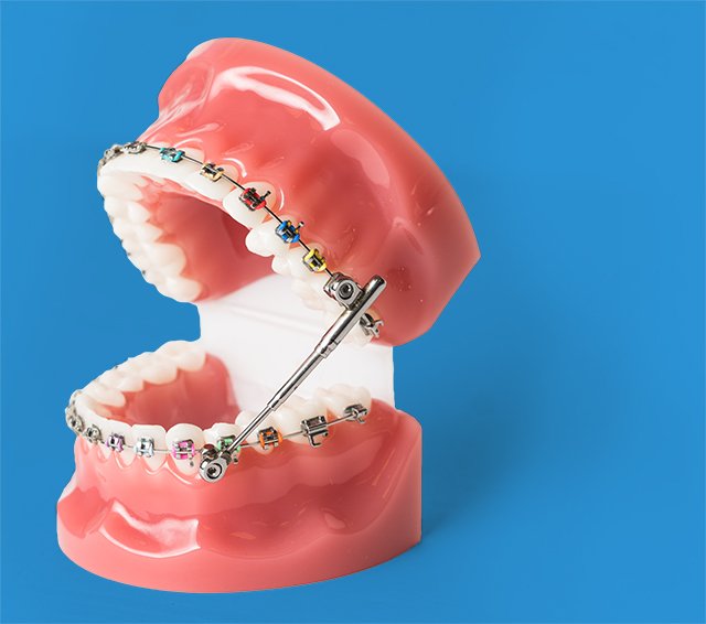 Braces Troy NY  Malsch Orthodontics Invisalign