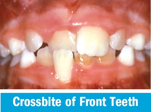 Anterior crossbite affecting a single upper front tooth