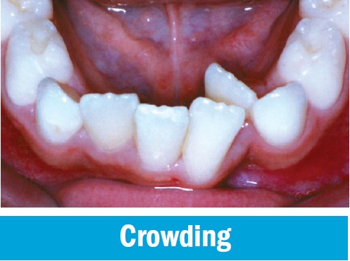 Crowded permanent front teeth without enough room to sit in line