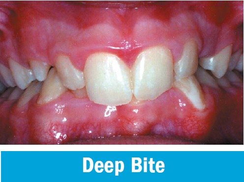 Deep bite, with the upper front teeth overlapping the lower front teeth too far