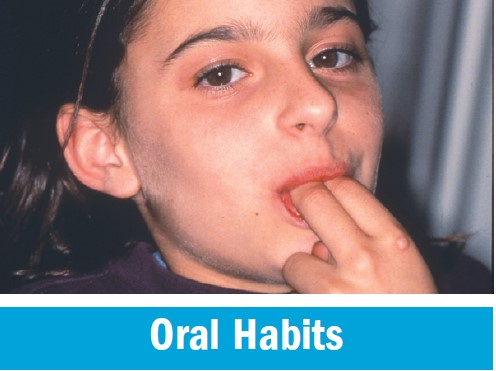 Front teeth pushed out of position by an oral habit such as thumb sucking