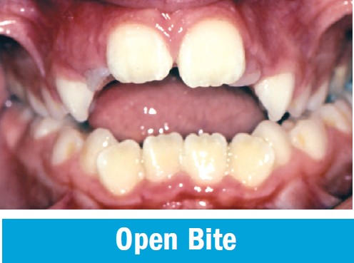 Open bite, with a gap between the upper and lower front teeth when the back teeth touch
