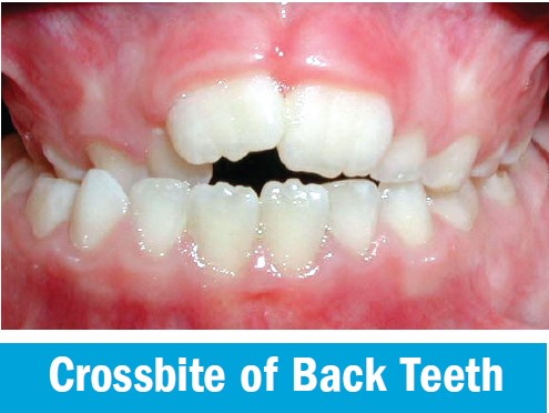 Posterior crossbite, where the upper back teeth sit inside the lower back teeth