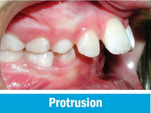 Protrusion, with the upper front teeth sitting well ahead of the lower front teeth