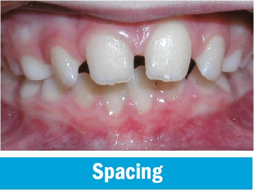 Gaps between the permanent front teeth