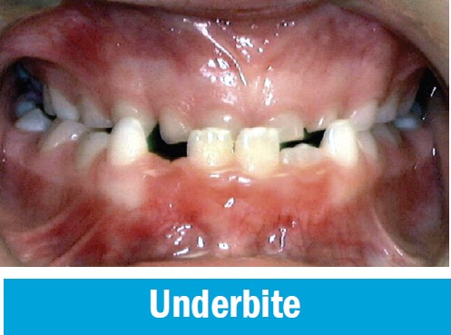 Underbite, with the lower front teeth sitting ahead of the upper front teeth