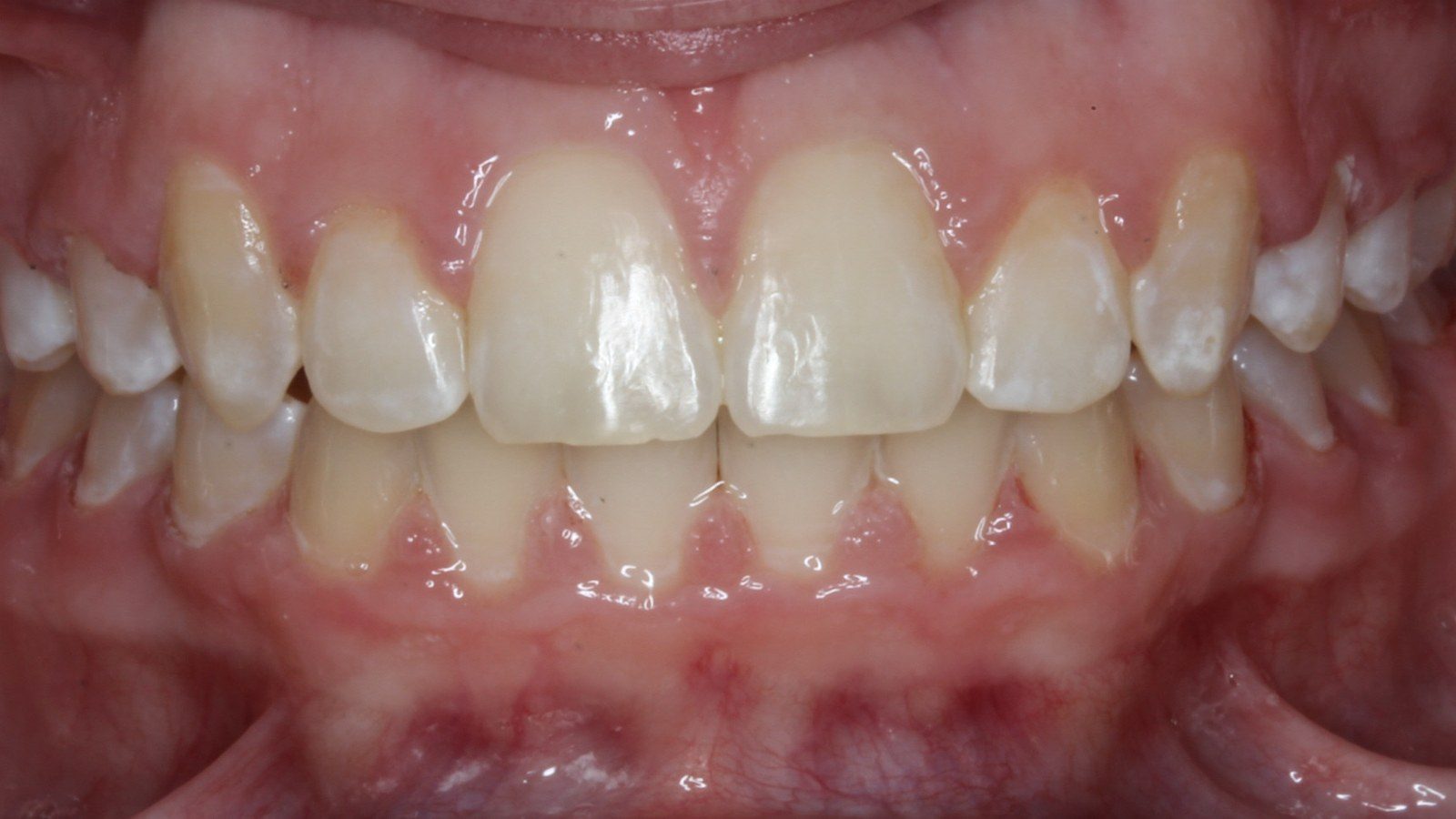 Case 01 smile after orthodontic treatment