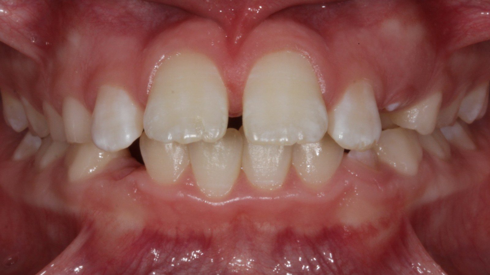 Case 01 smile before orthodontic treatment