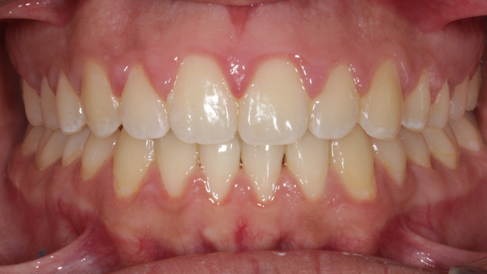 Case 04 smile after orthodontic treatment