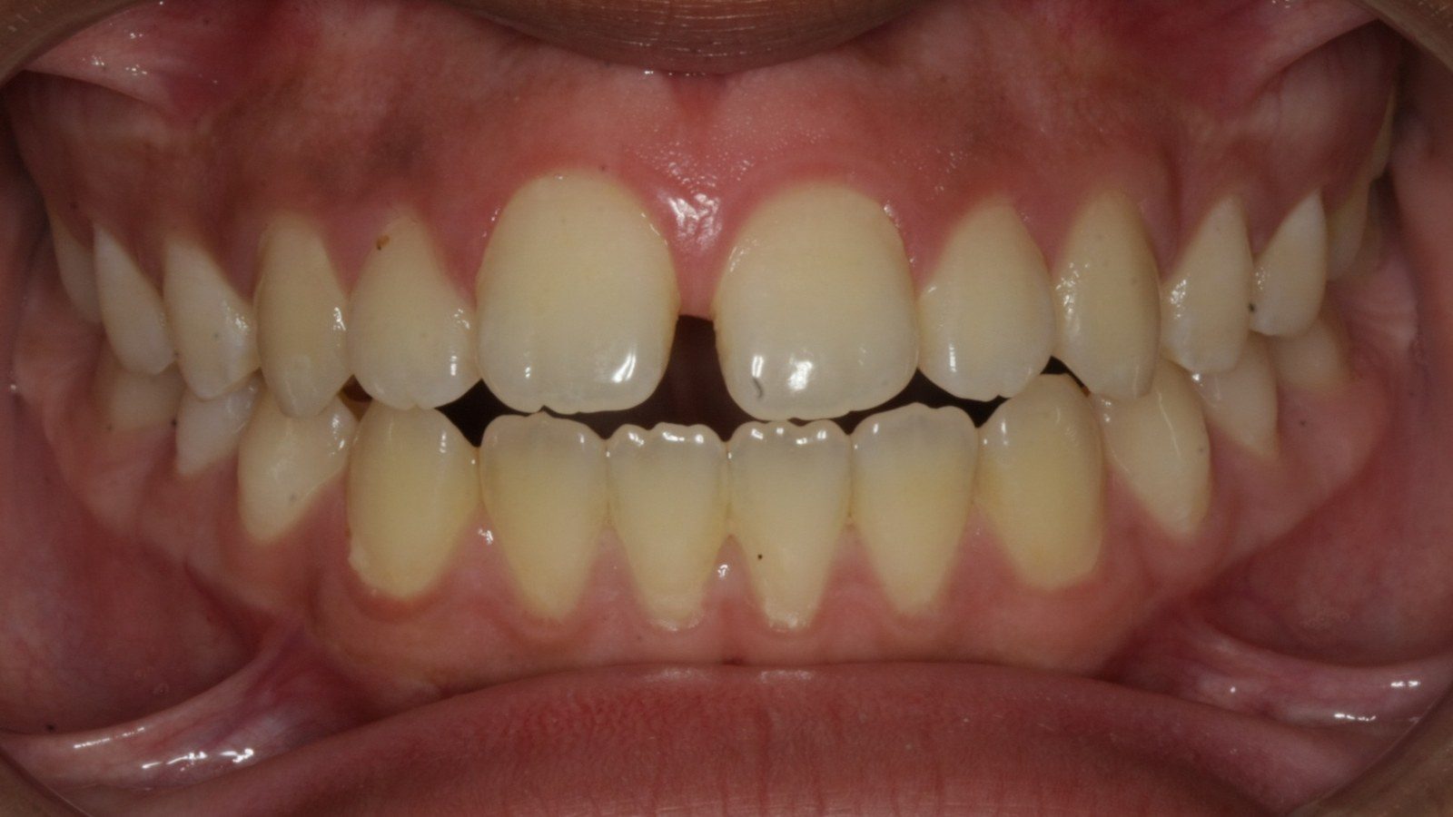 Case 04 smile before orthodontic treatment