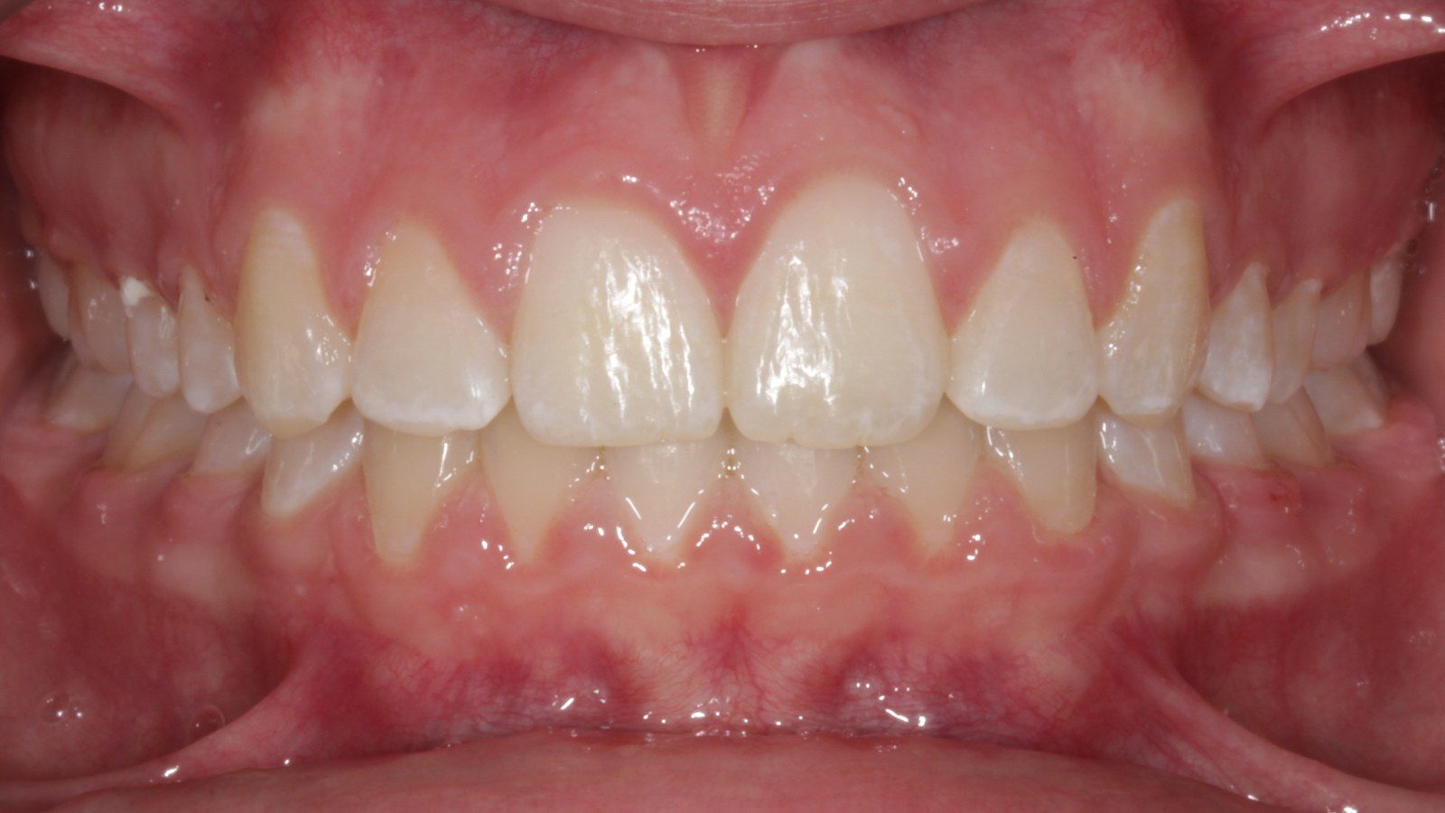 Case 05 smile after orthodontic treatment