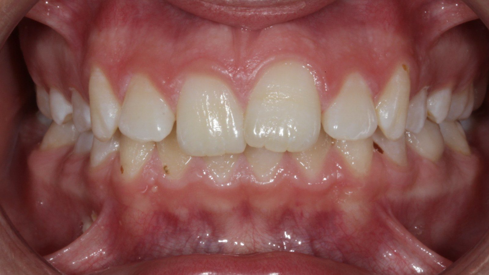 Case 05 smile before orthodontic treatment