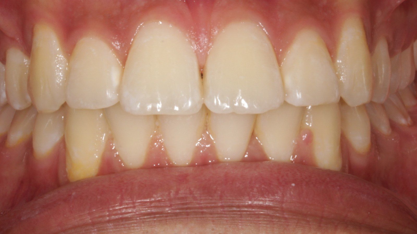 Case 06 smile after orthodontic treatment