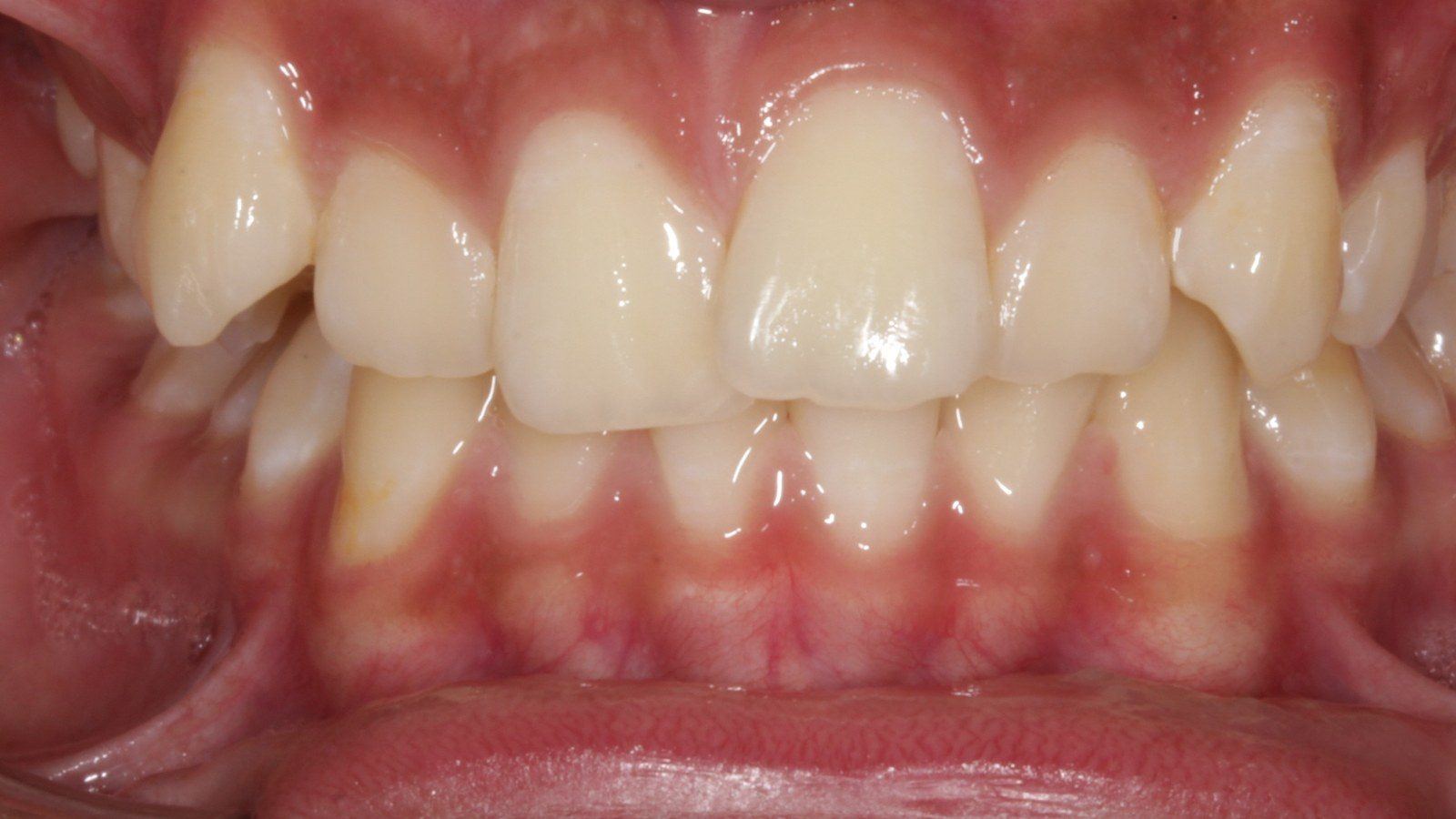 Case 06 smile before orthodontic treatment