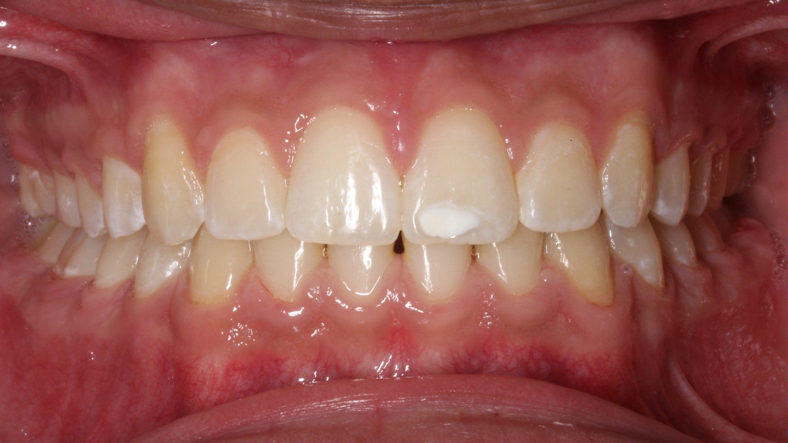 Case 07 smile after orthodontic treatment
