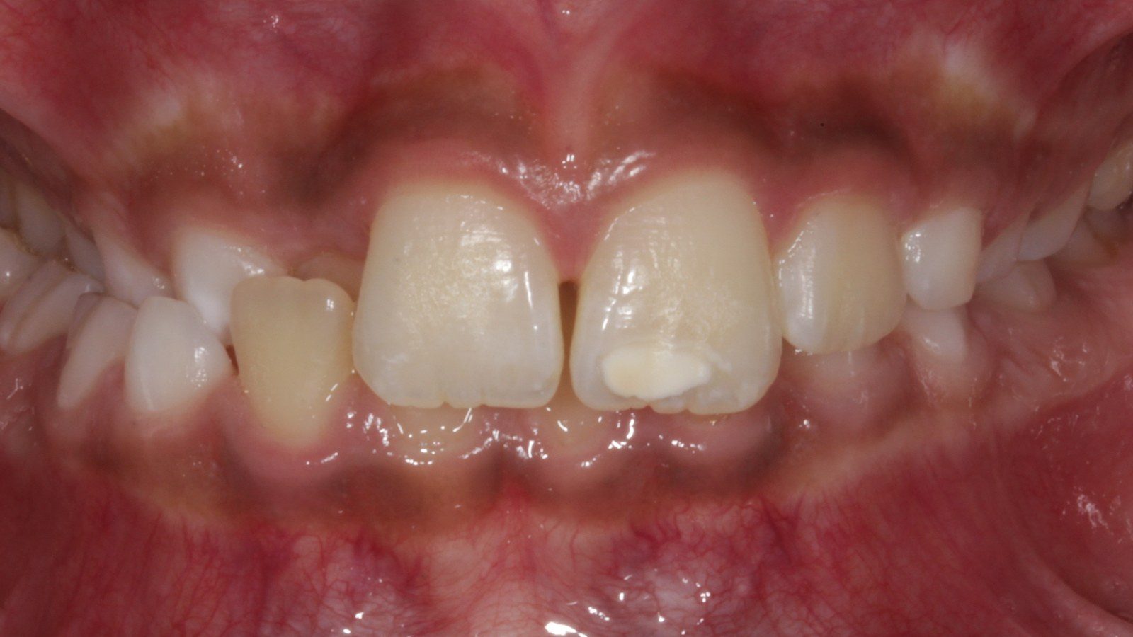 Case 07 smile before orthodontic treatment