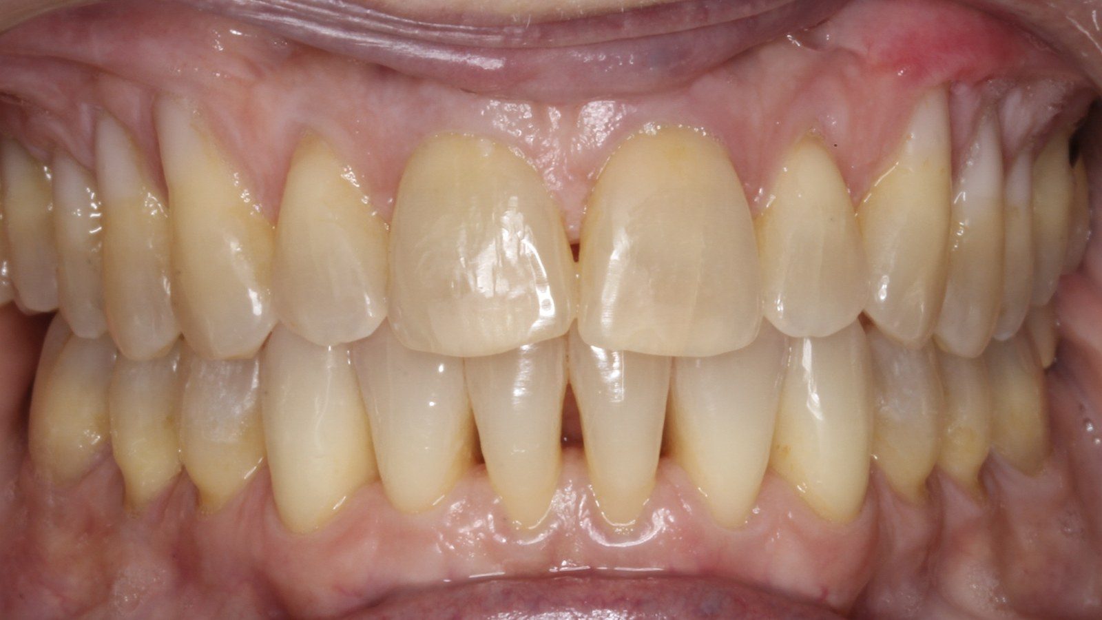 Case 08 smile after orthodontic treatment