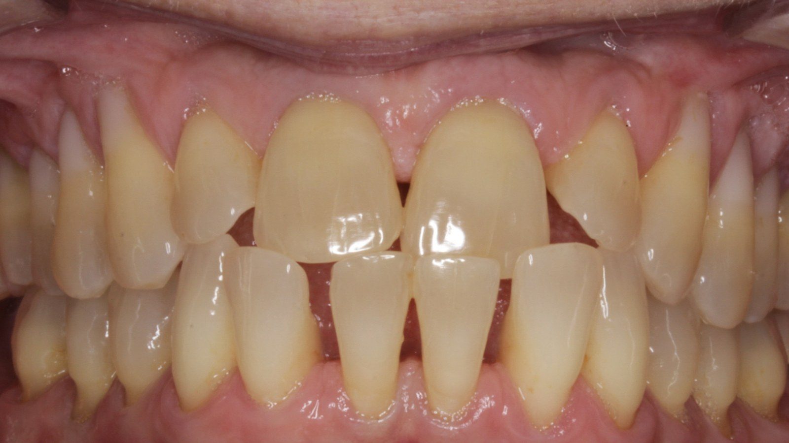 Case 08 smile before orthodontic treatment