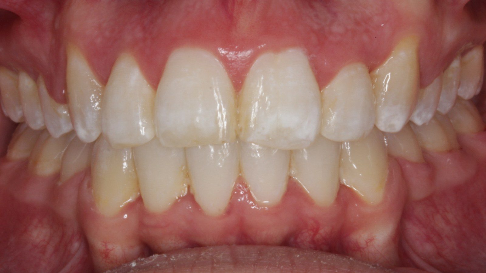 Case 09 smile after orthodontic treatment