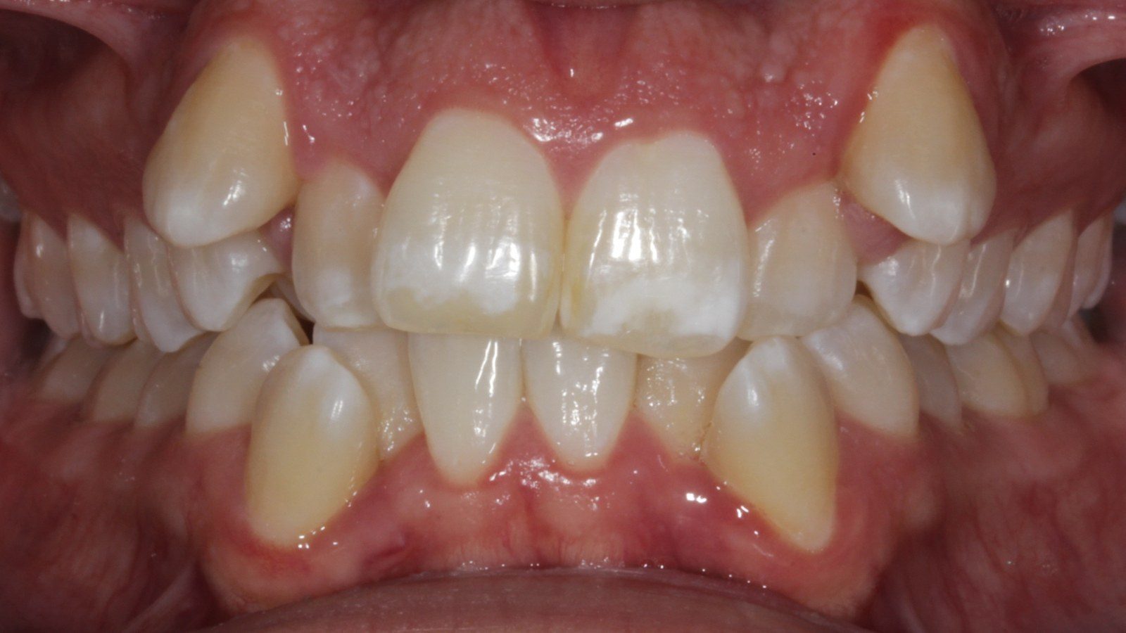 Case 09 smile before orthodontic treatment