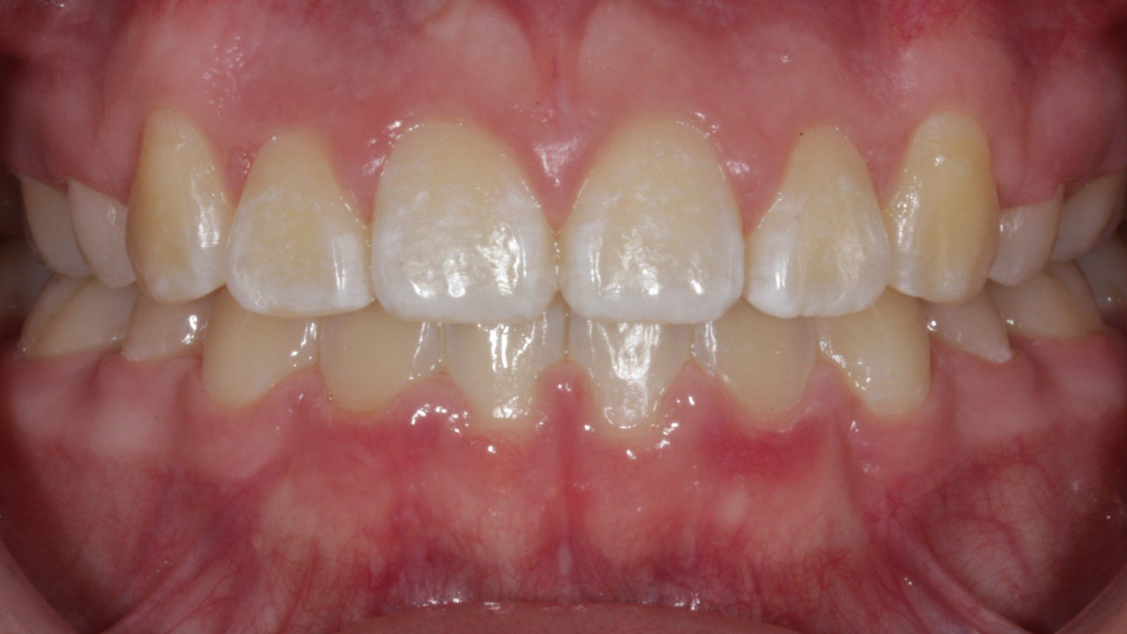 Case 10 smile after orthodontic treatment