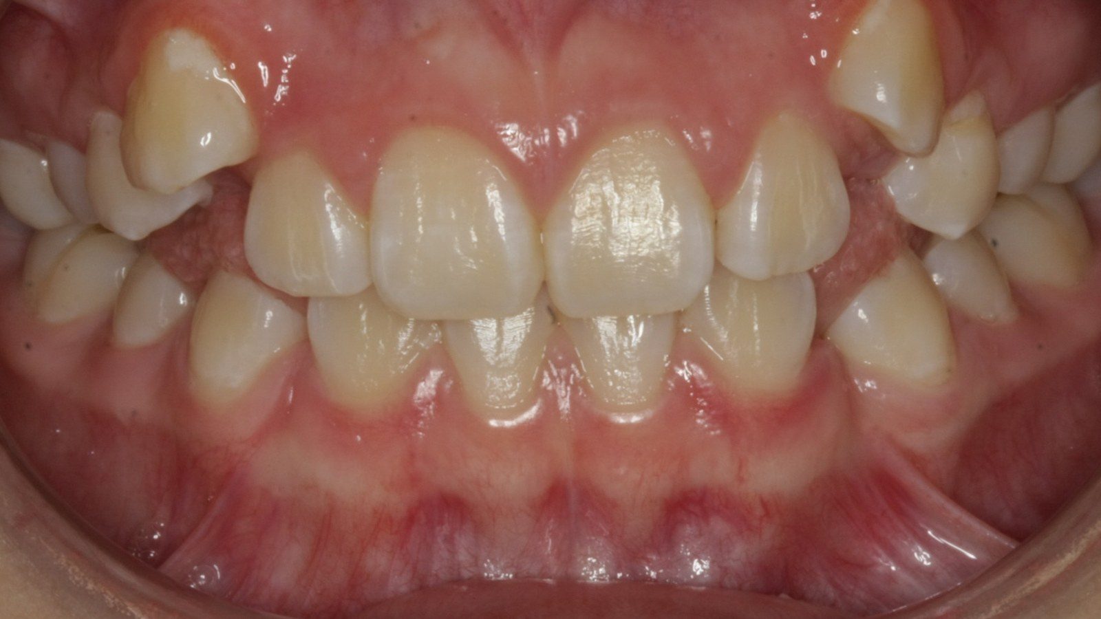 Case 10 smile before orthodontic treatment