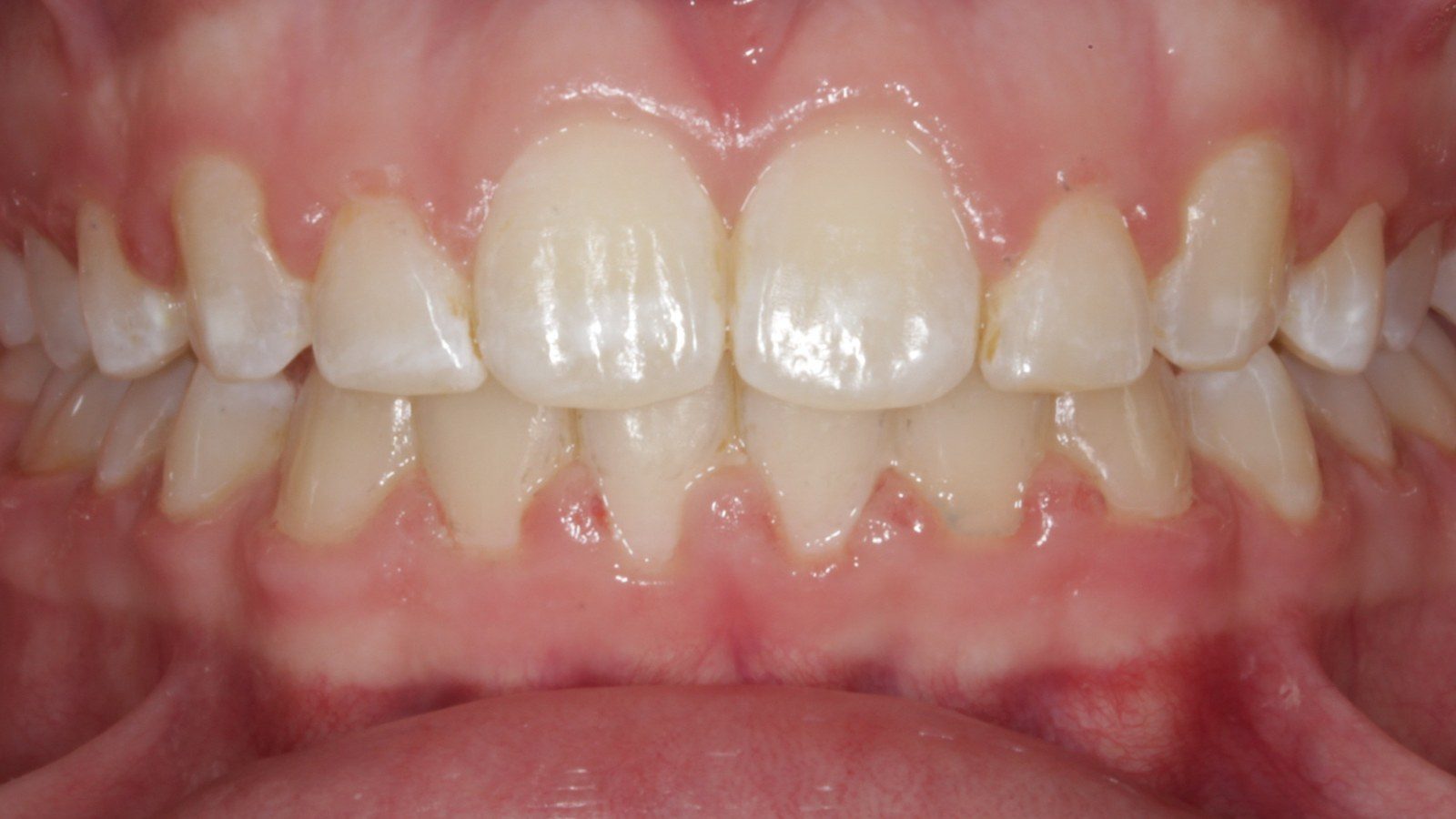 Case 12 smile after orthodontic treatment
