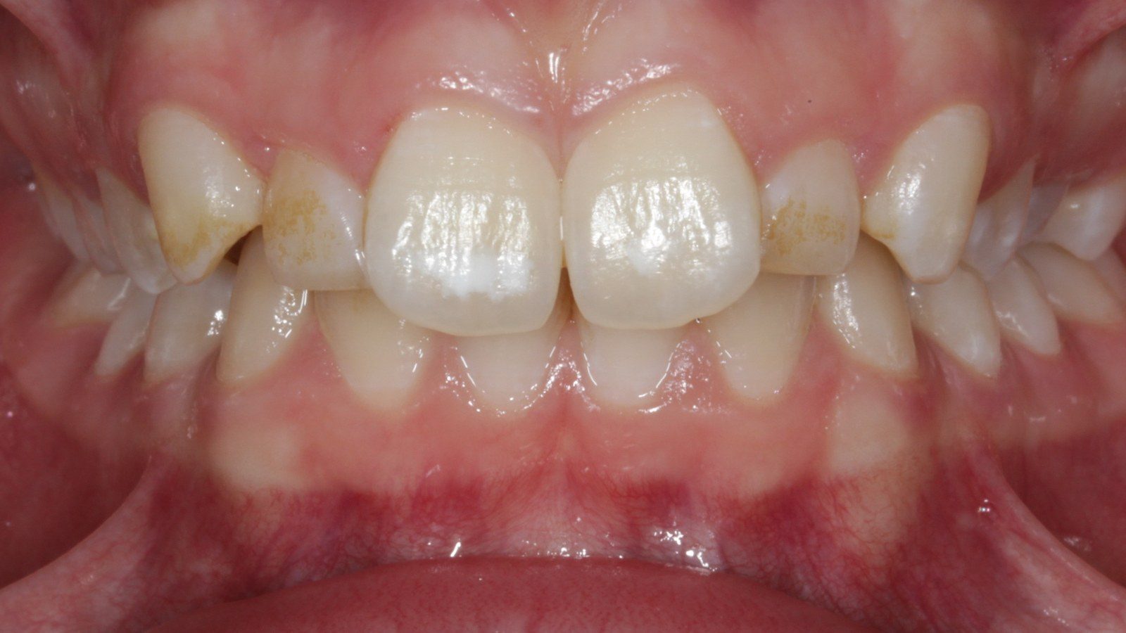 Case 12 smile before orthodontic treatment