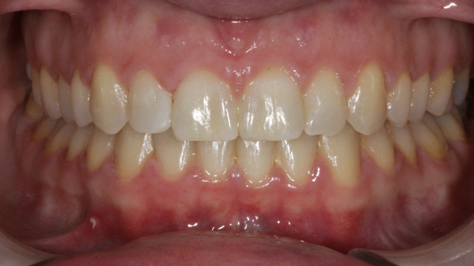 Case 13 smile after orthodontic treatment