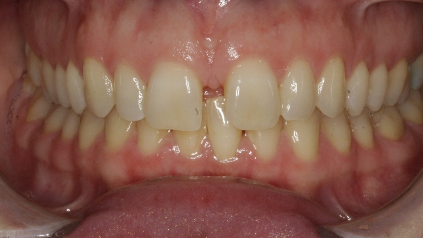 Case 13 smile before orthodontic treatment