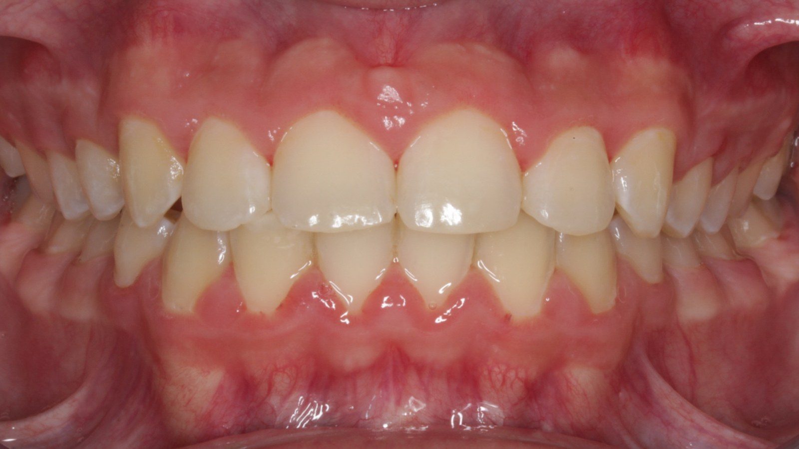 Case 14 smile after orthodontic treatment