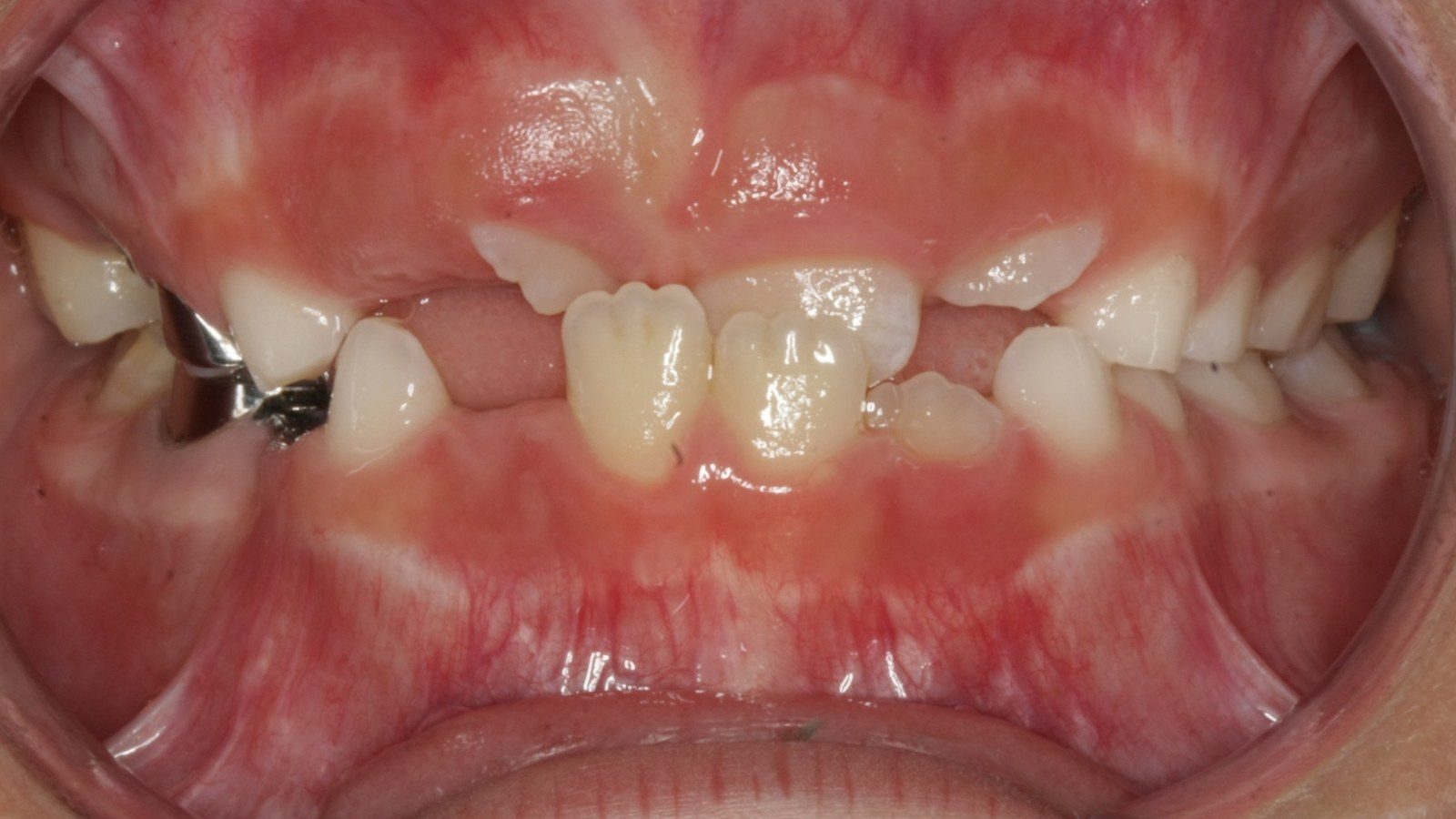 Case 14 smile before orthodontic treatment