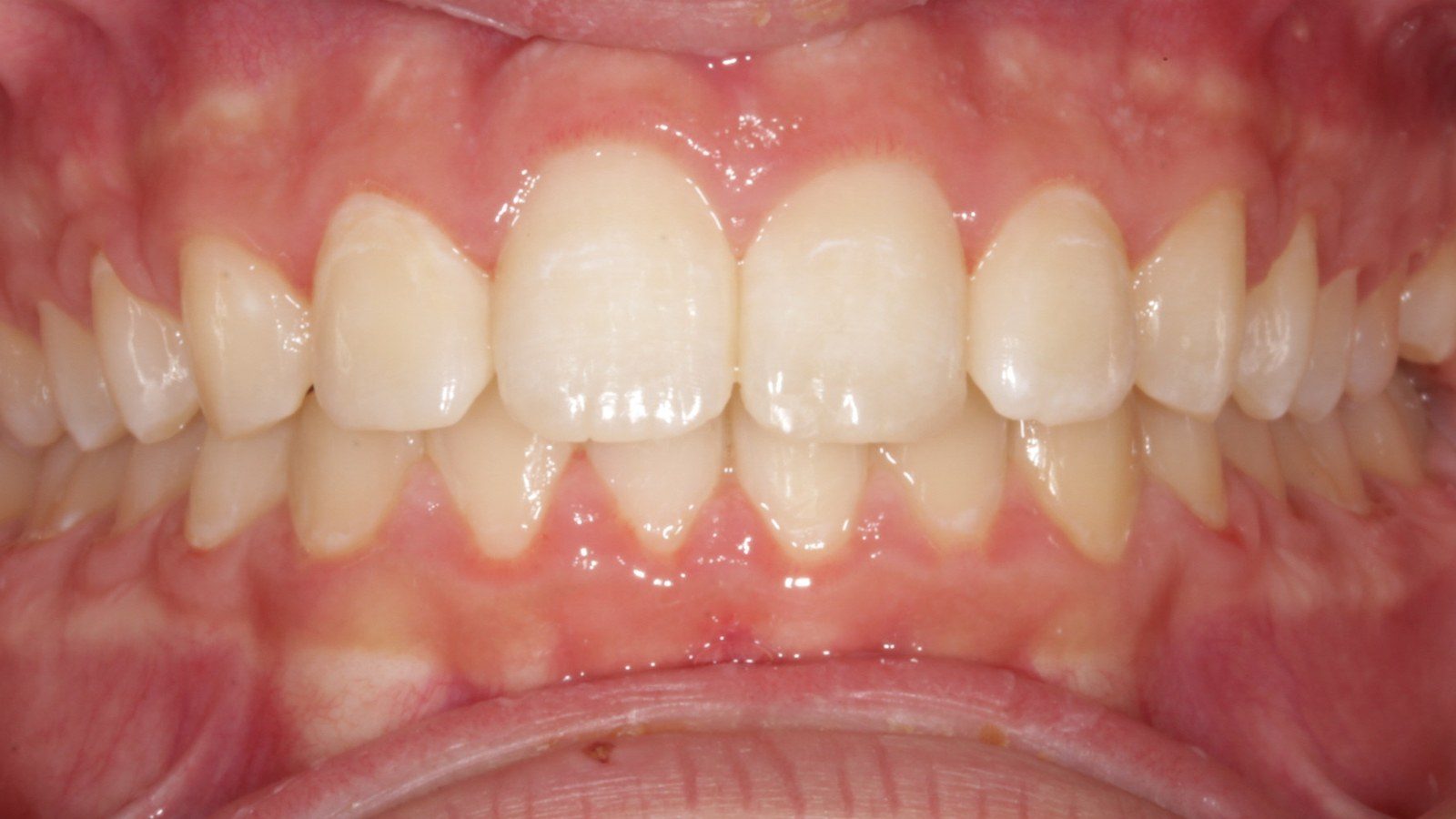 Case 15 smile after orthodontic treatment