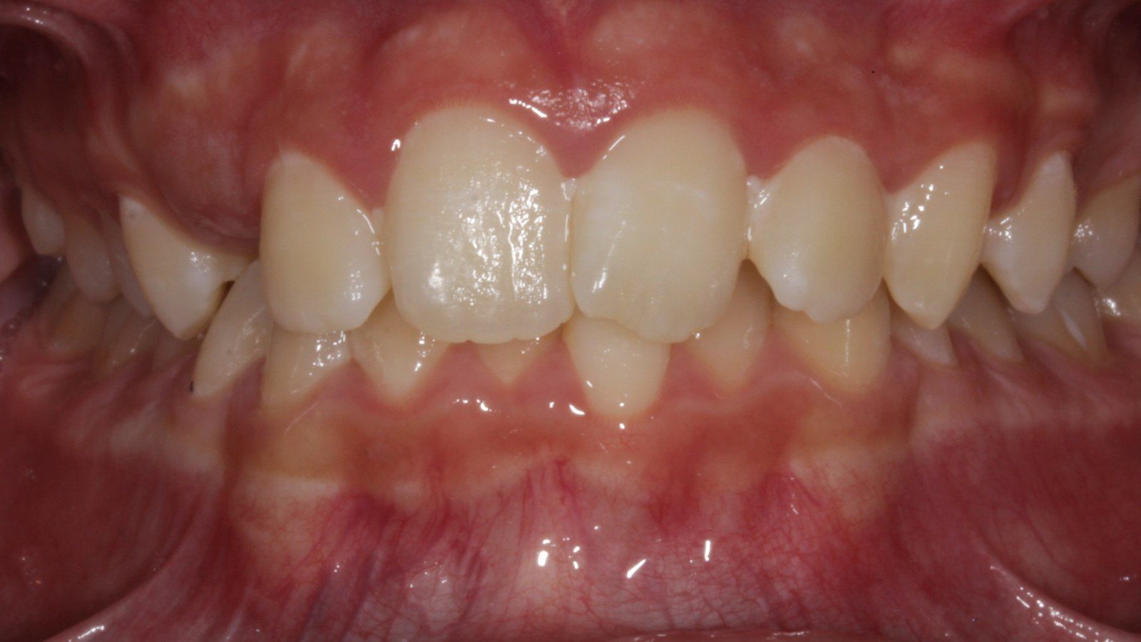 Case 15 smile before orthodontic treatment
