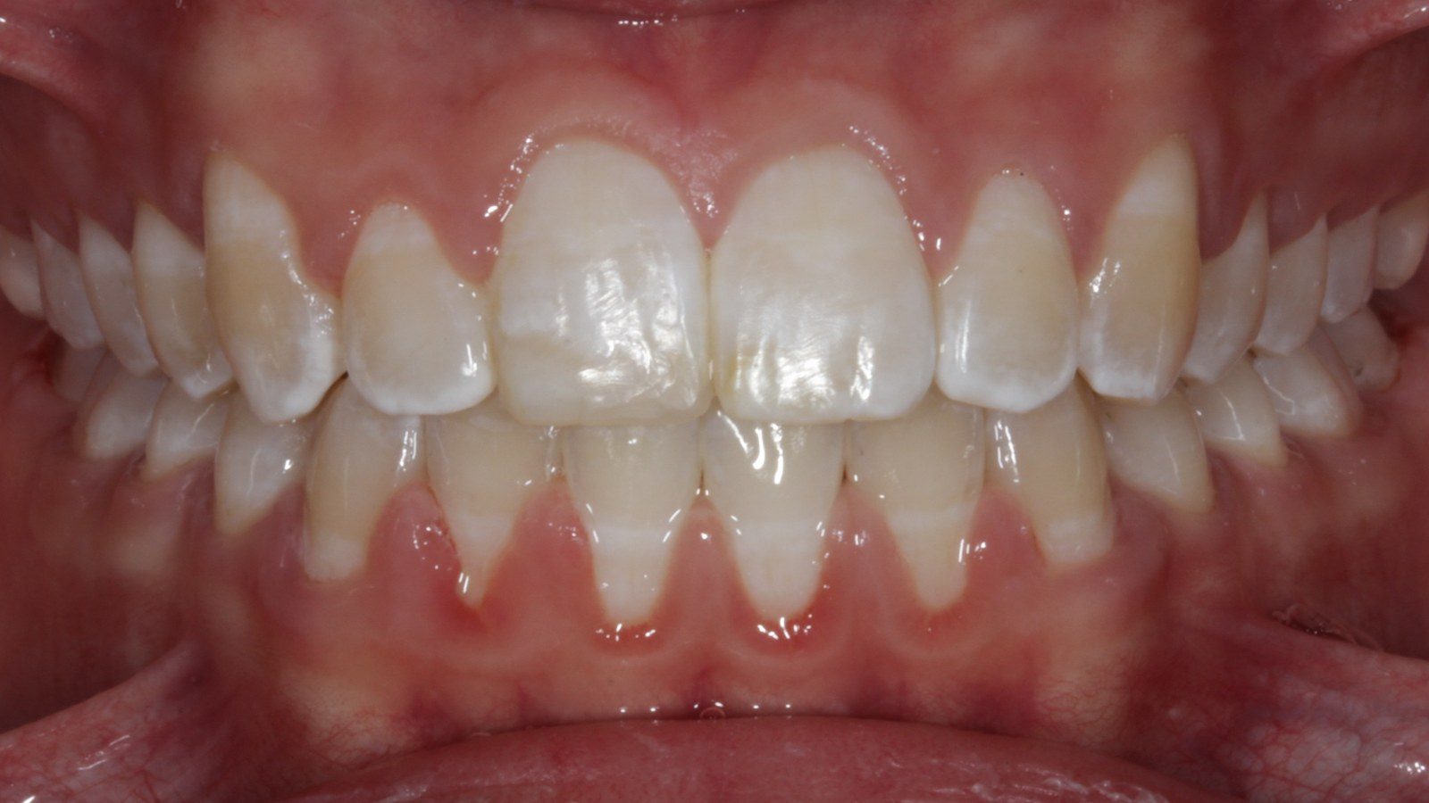 Case 17 smile after orthodontic treatment