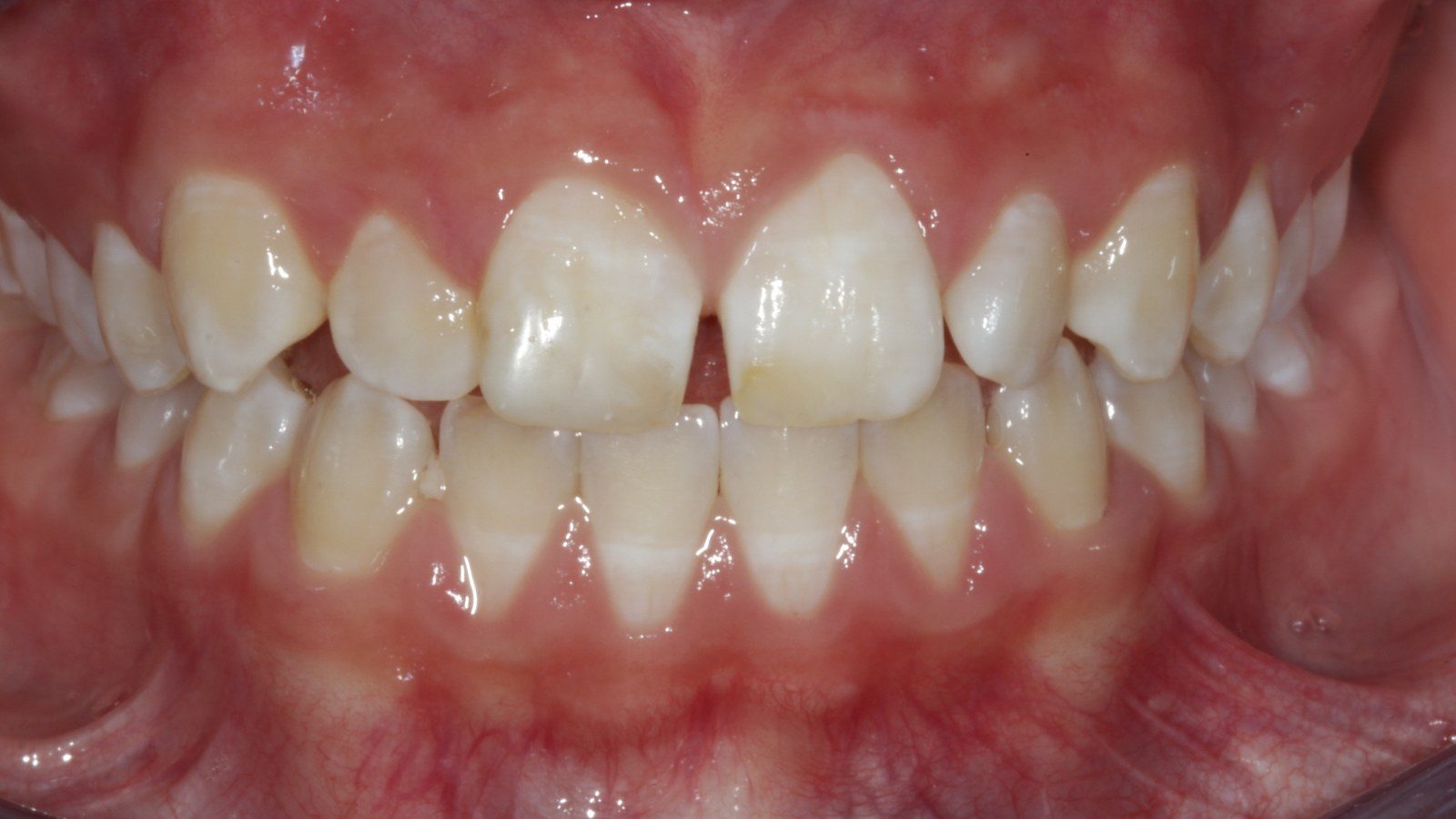 Case 17 smile before orthodontic treatment
