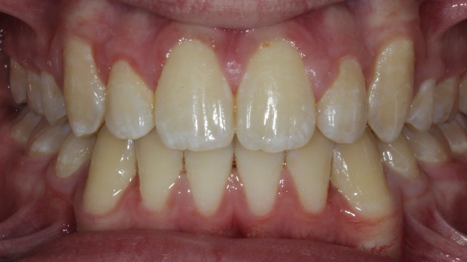 Case 18 smile after orthodontic treatment