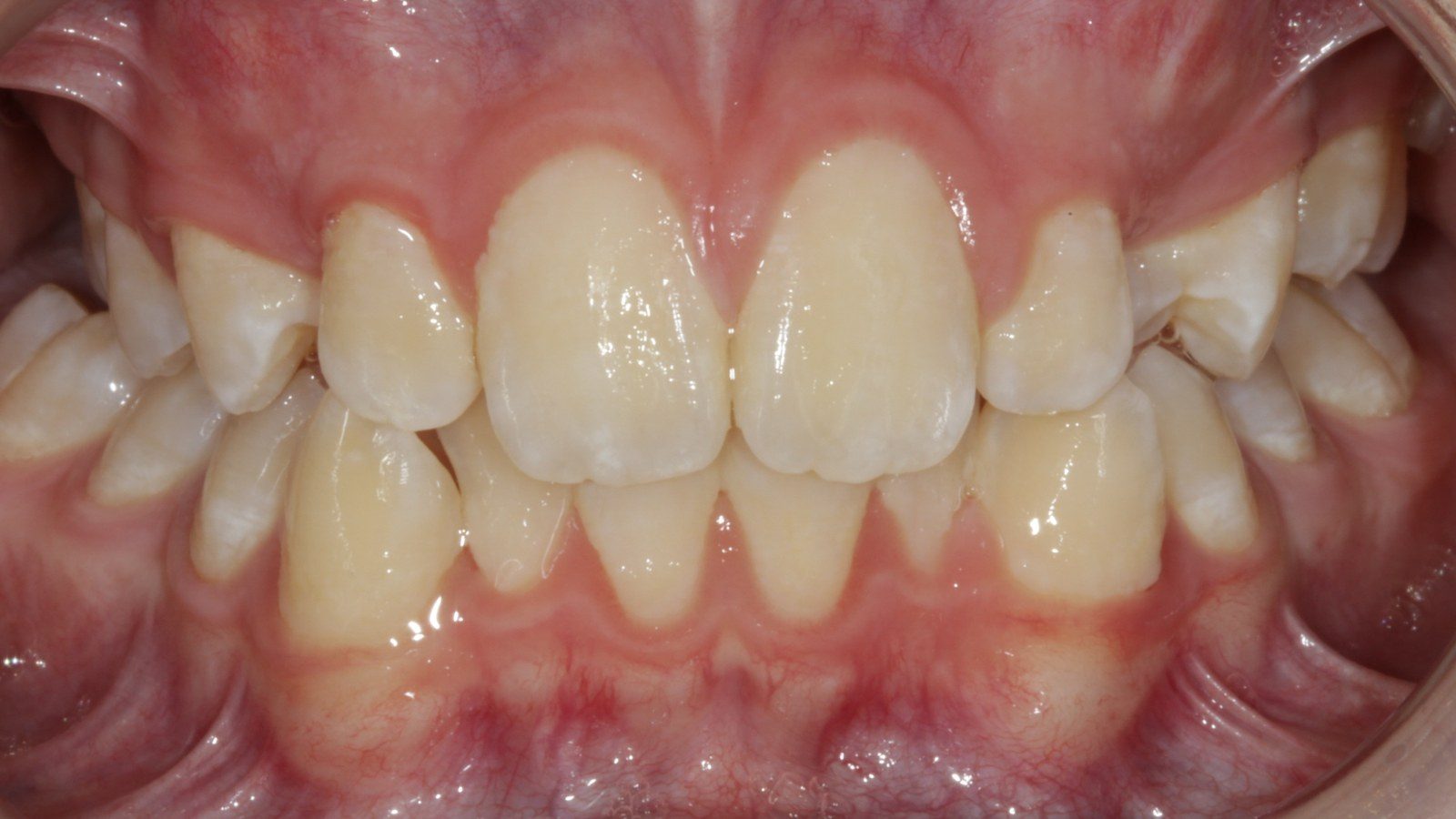 Case 18 smile before orthodontic treatment