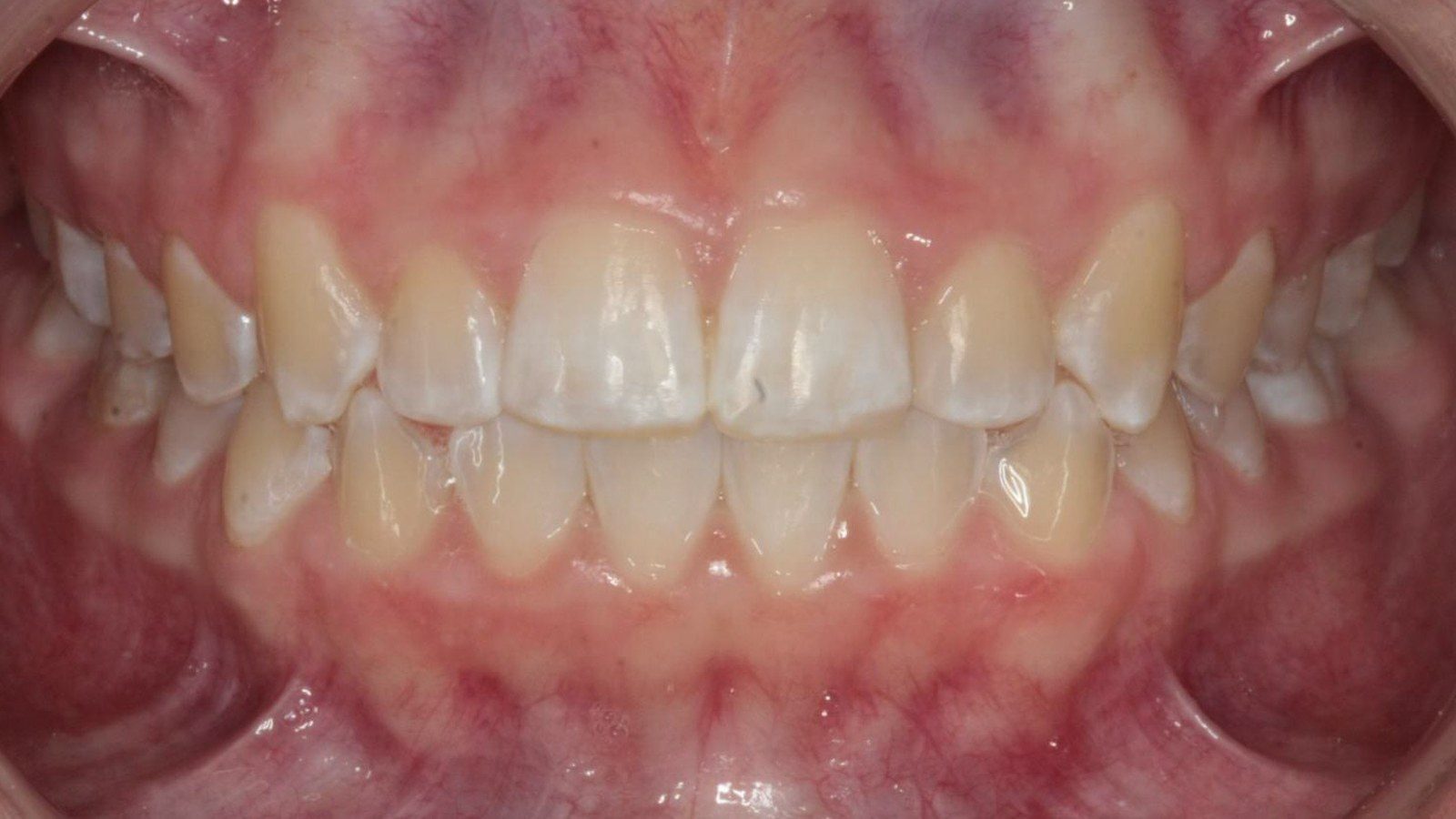 Case 21 smile after orthodontic treatment