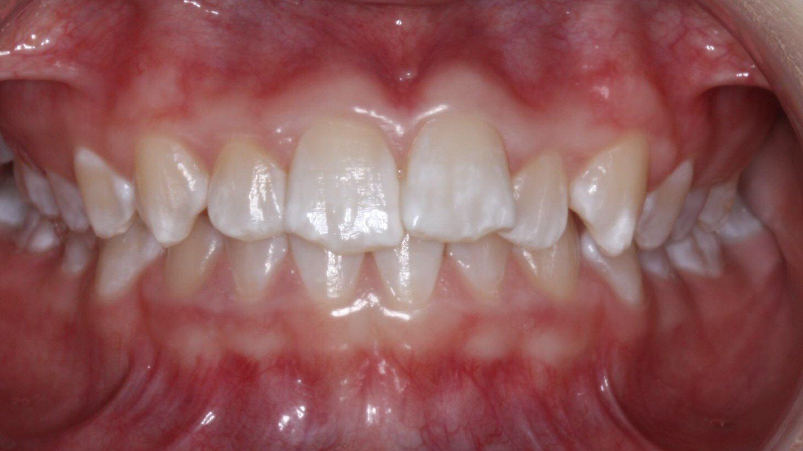 Case 21 smile before orthodontic treatment