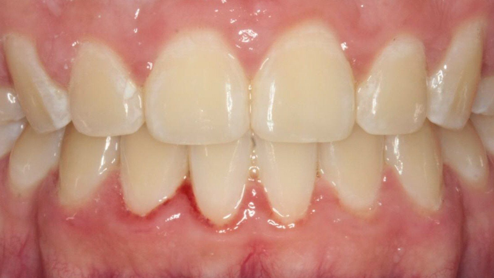 Case 23 smile after orthodontic treatment