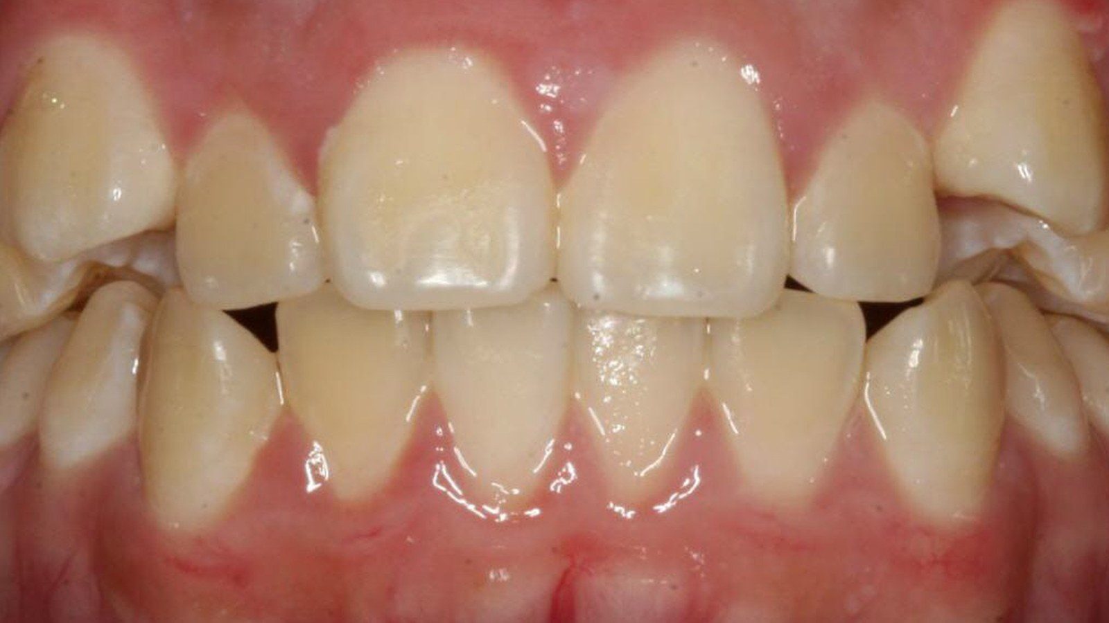 Case 23 smile before orthodontic treatment