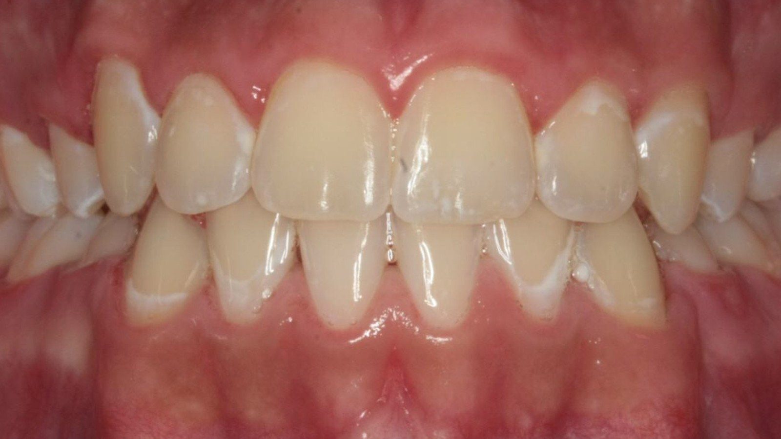 Case 24 smile after orthodontic treatment