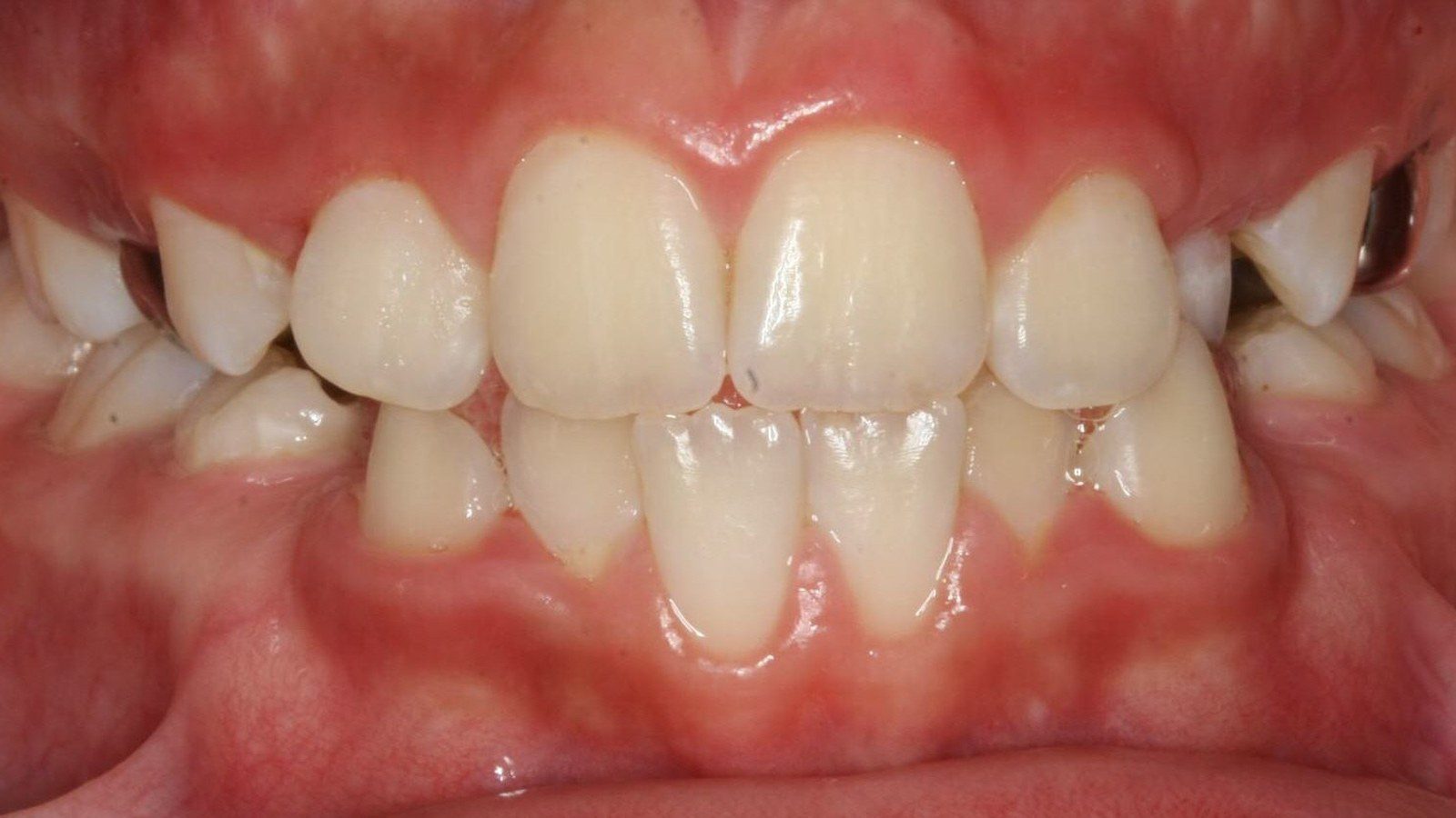 Case 24 smile before orthodontic treatment