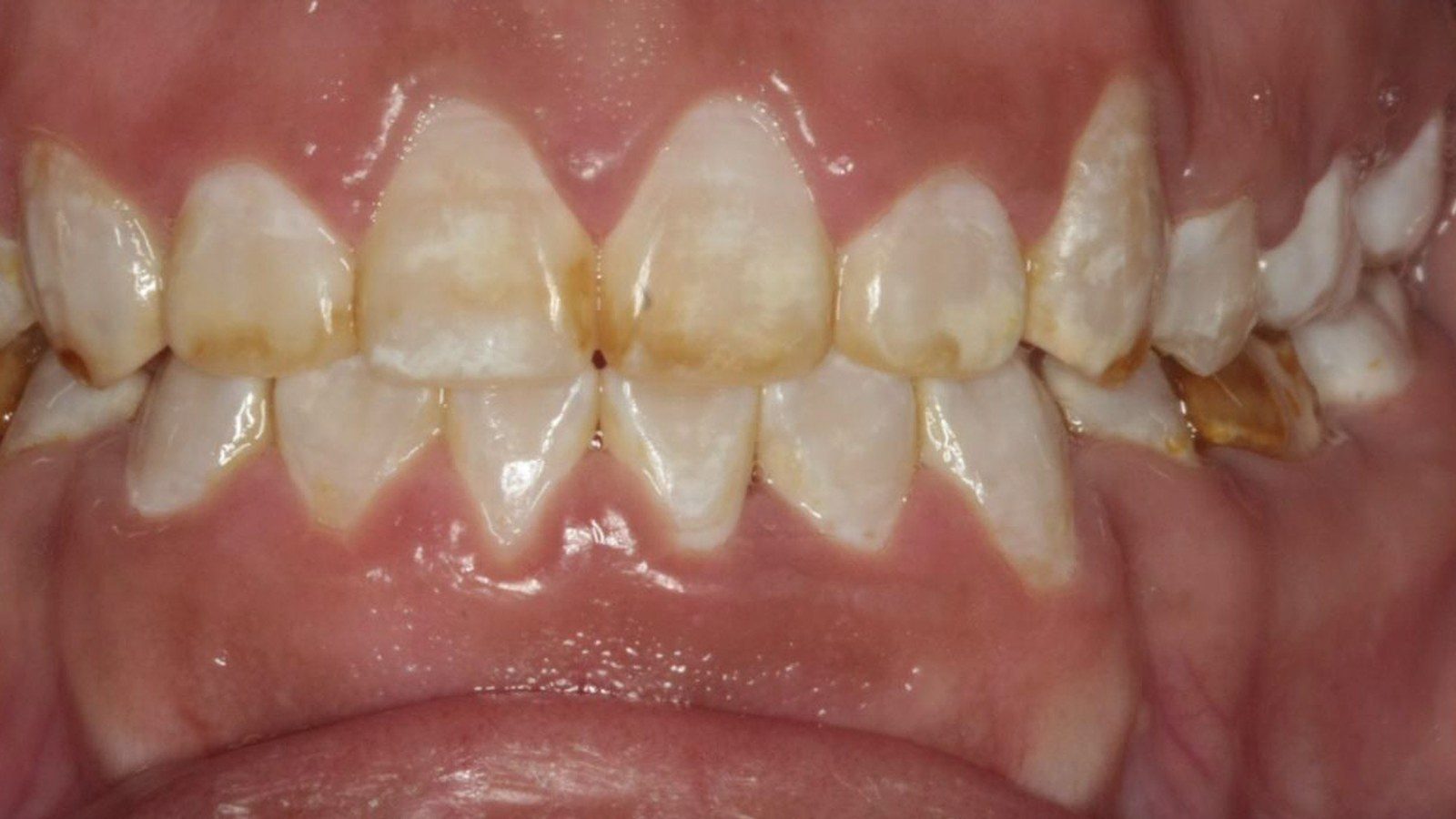 Case 26 smile after orthodontic treatment