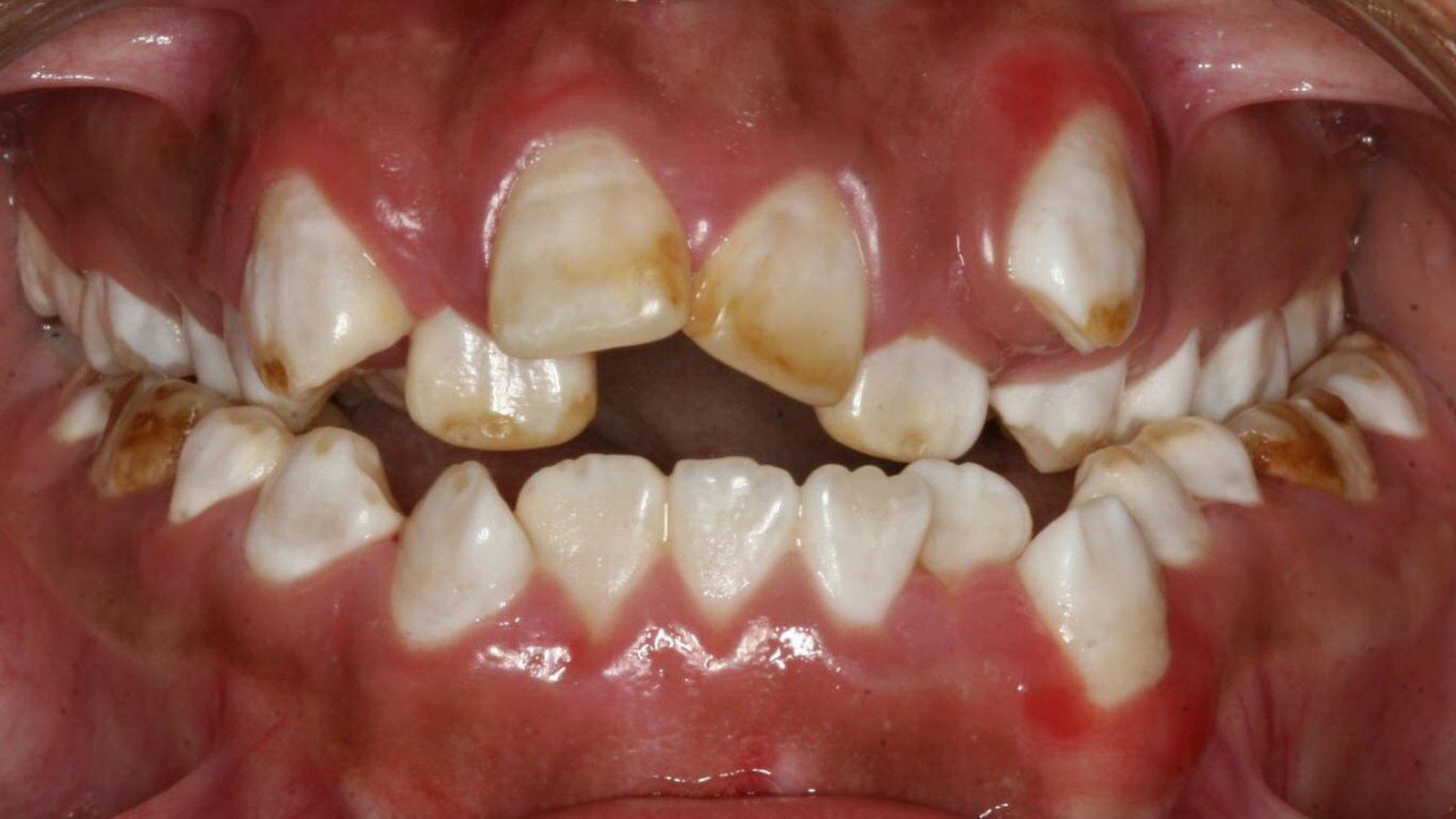 Case 26 smile before orthodontic treatment