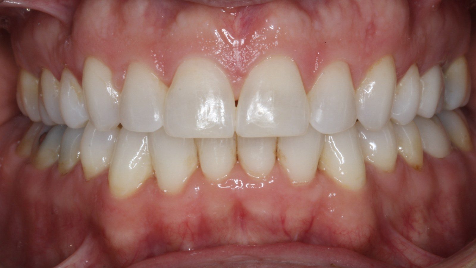 Case 27 smile after orthodontic treatment