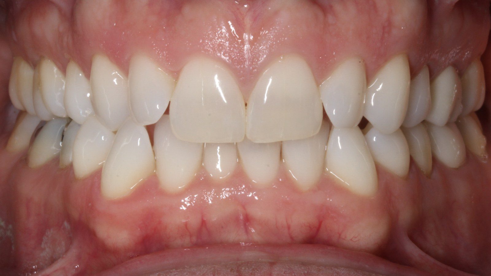 Case 27 smile before orthodontic treatment