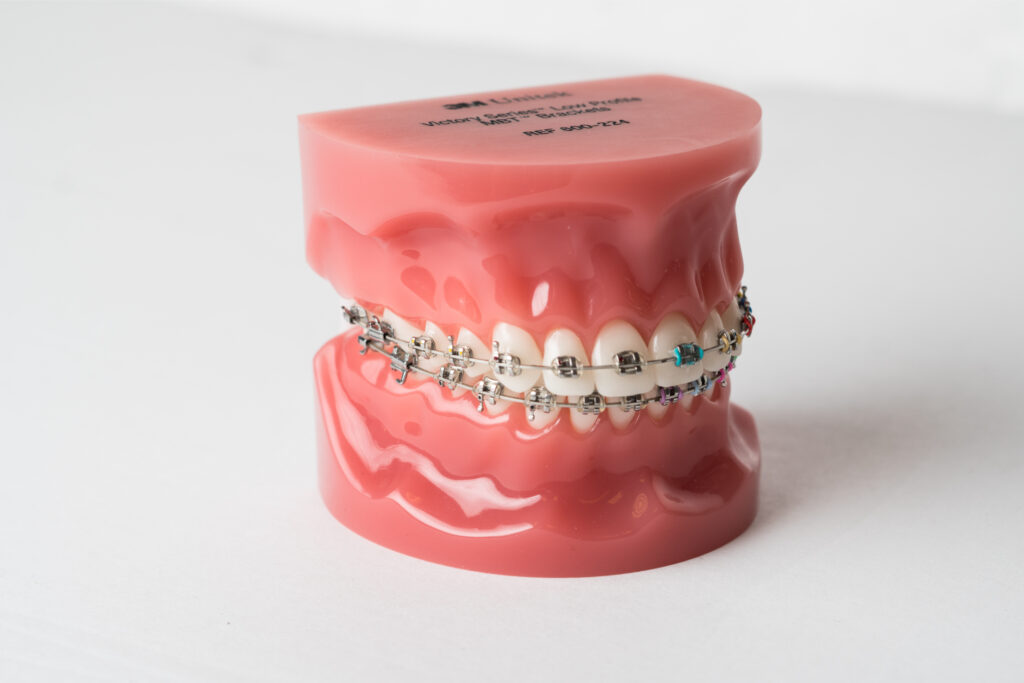 Dental model showing metal braces with brackets and wires on the upper and lower teeth